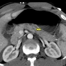 Traumatic pancreatic rupture. Left: CT. Right: MRI confirmation.