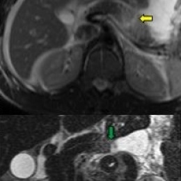 Traumatic pancreatic rupture. Left: CT. Right: MRI confirmation.