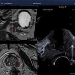 Gezielte Stanzbiopsie mit Visualisierung des Tumors in 2 Ebenen im MRT und live...