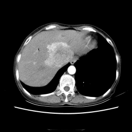 Central hypervascularised liver tumour.