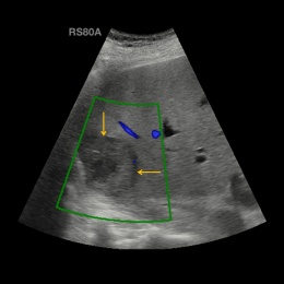 Increased vascularisation of the lesion
(yellow arrow) is not visible in...