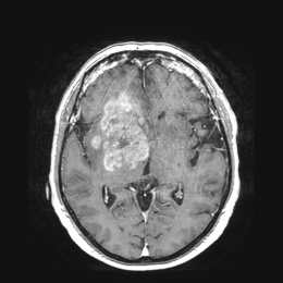 Gehirntumor eines Patienten, bei dem vor Jahren ein multiples Myelom...