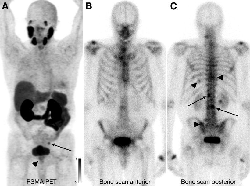 A 74-year-old man at initial staging with PSMA PET that demonstrates low uptake...