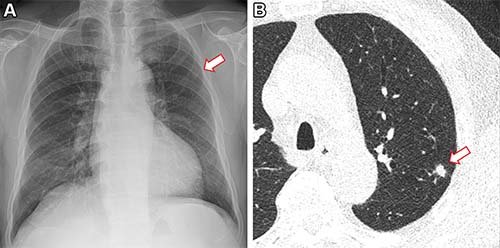 Frontal chest X-ray shows a small nodular opacity (arrow) in the left upper...