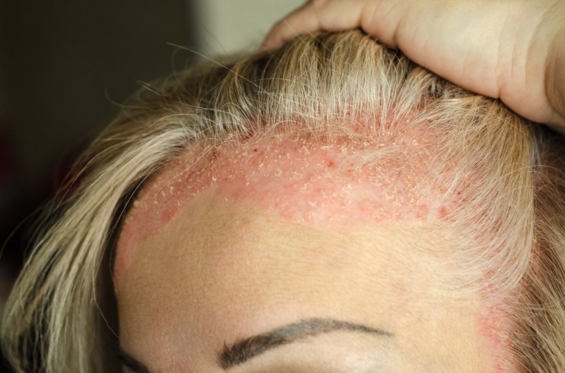 female patient showing psiorasis skin condition on scalp