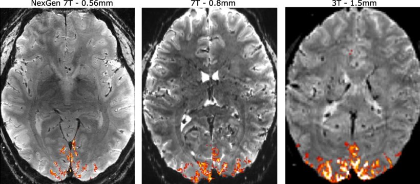 A comparison of human brain scans using the NexGen 7T MRI at higher resolution...