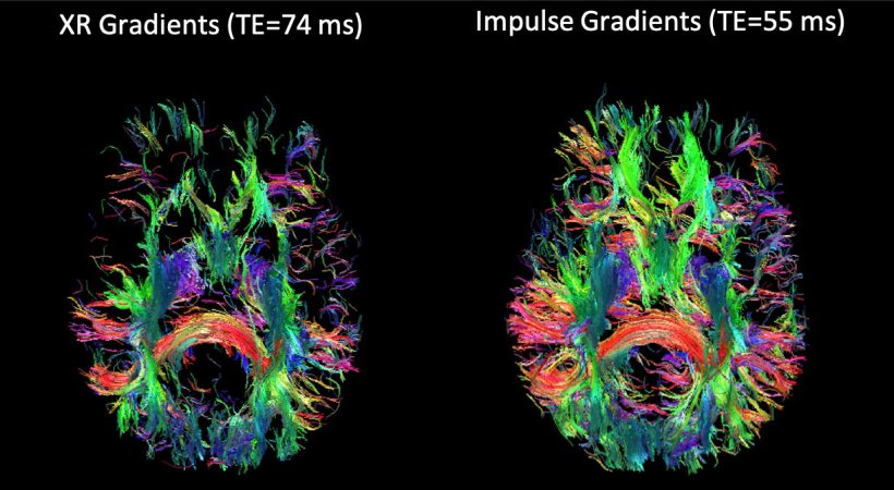 Diffusion MRI imaging — called tractography — of the bundles of axons that...
