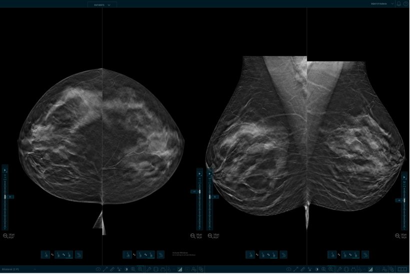 Transforming breast screening: The role of AI in improving reading workflow