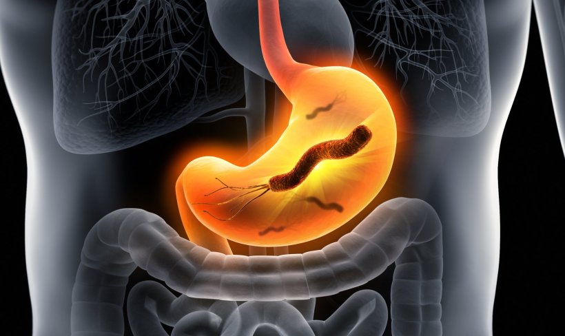 illustration of gastrointestinal stomach infection with helicobacter pylori...