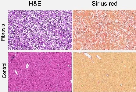 Stained tissue from mice with experimental liver fibrosis (top) compared to...
