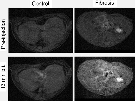 In mice with liver fibrosis a bright MRI image of fibrotic regions is seen just...