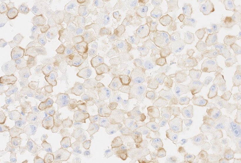 Senescent human melanoma tumour cells. In brown, the PD-L2 protein acts as a...