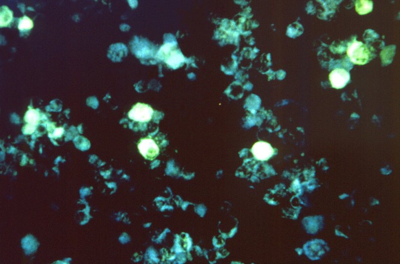 cells infected with the Epstein Barr virus (EBV)