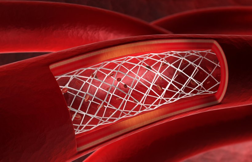 blood vessel with stent implant
