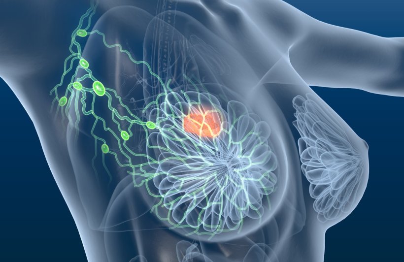 3d illustration of transparent female upper body with breast cancer and lymph...