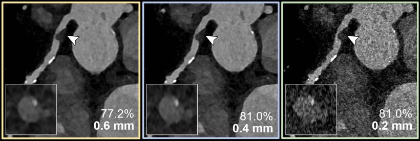 Coronary CT angiography for the suspected progression of known coronary artery...