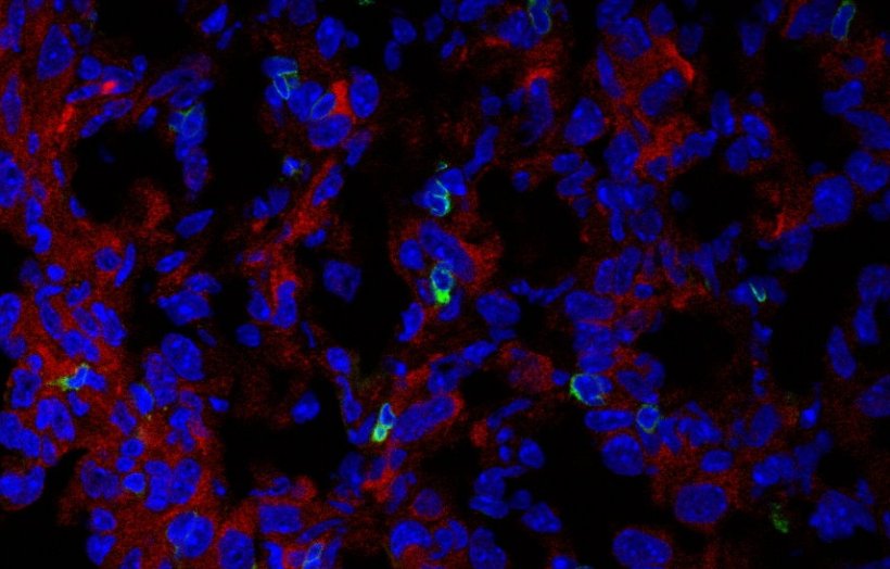 Immunfluoreszenzbild der Expression von PHGDH (rot) und CD3-T-Zellen (grün) im...