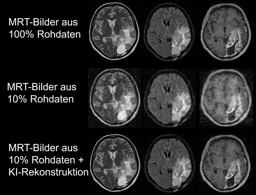 Die MRT-Bilder zeigen den Kopf eines Patienten mit einem Gehirntumor. Die...