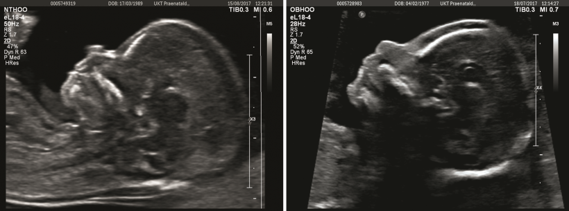 Linkes Bild: Unauffälliges fetales Profil in der 12+2...