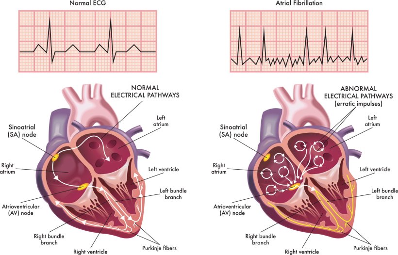 Medical illustration showing the symptoms of a heart with atrial fibrillation...