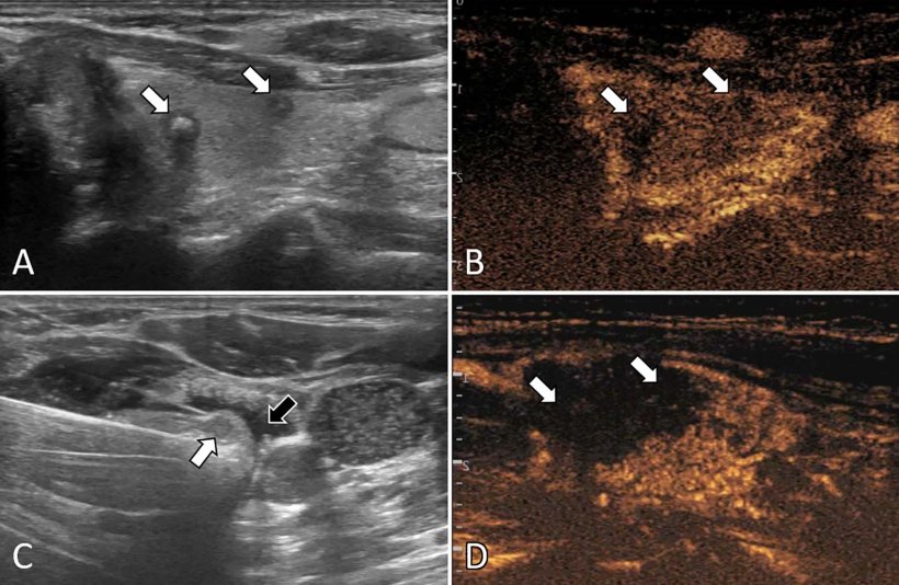 Ultrasound (US) images in a 57-year-old female patient with multifocal...