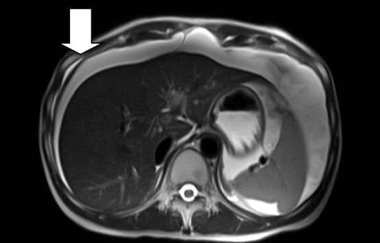 MRT-Aufnahme eines Patienten mit Bauchfellkrebs. Der Pfeil zeigt die typische...