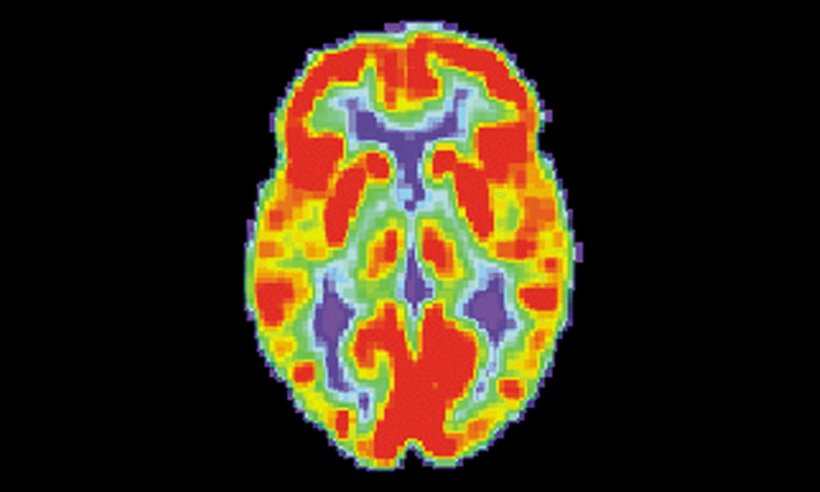 PET-Aufnahme eines (gesunden) Gehirns