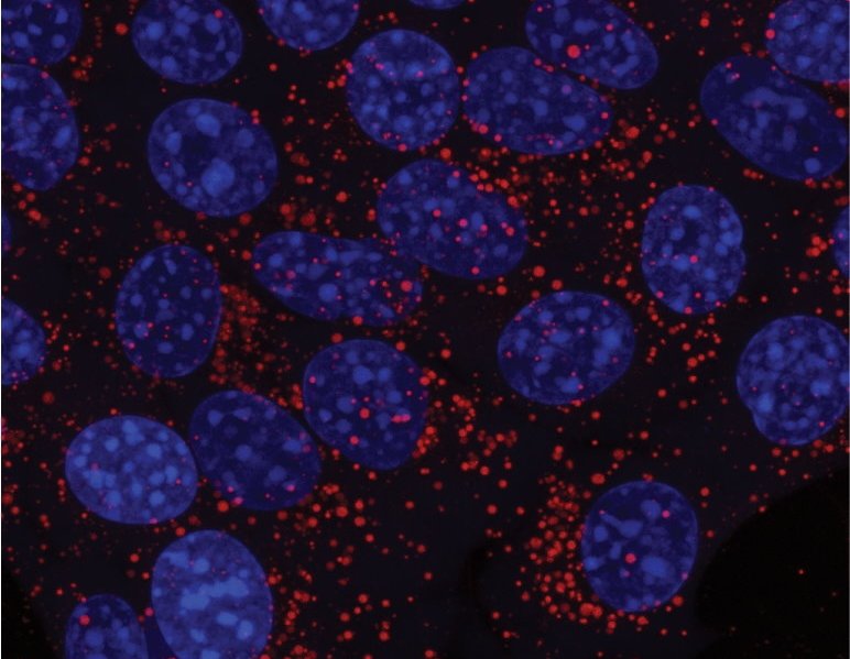 Krebszellen (Zellkerne in blau), die Lipide in Form von Lipidtröpfchen (rot)...