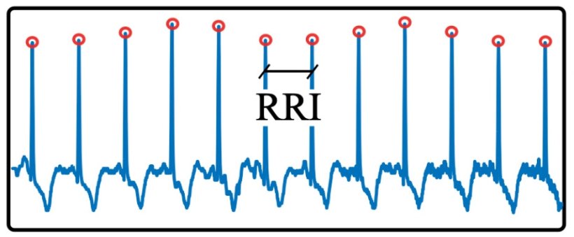An R-to-R interval (RRI) is the period of time between the peaks of two...