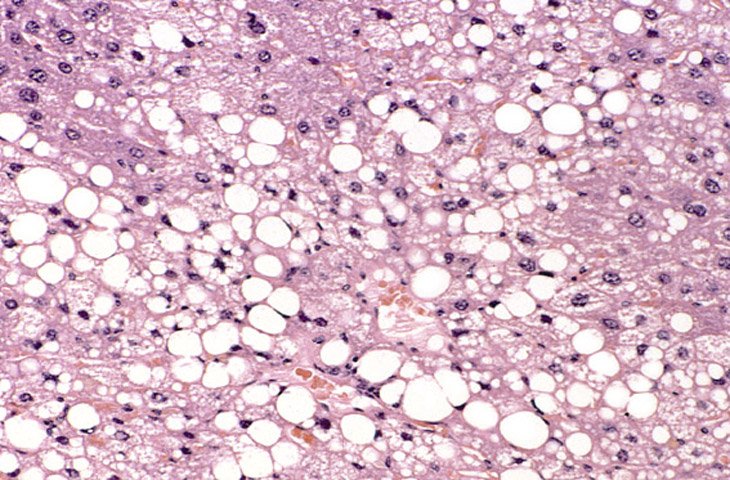 Histological section of a murine liver showing severe steatosis