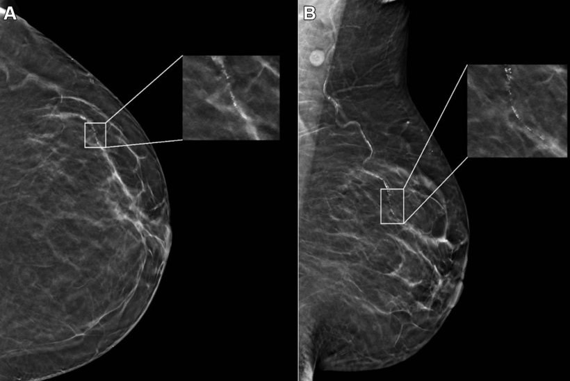 mammography scan of black womans breasts
