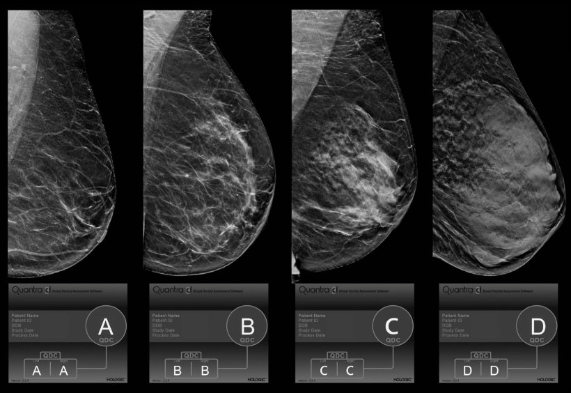 ai evaluation of breast mammograms