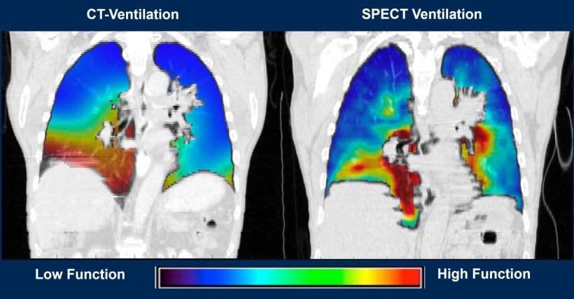 human lung imaging with CT and SPECT