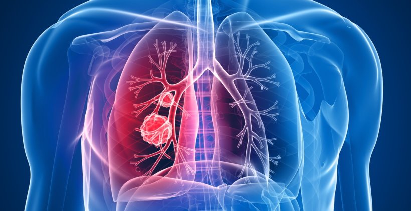 3d rendering of human thorax anatomy with lung cancer highlighted in red