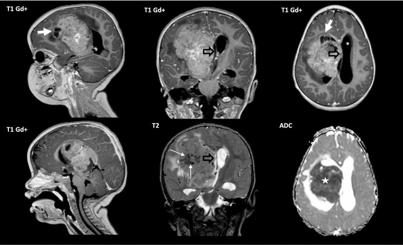 ct images of children with brain tumours