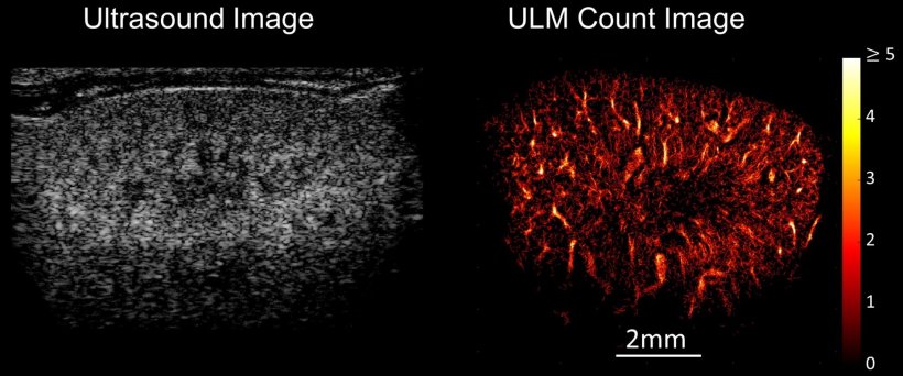 Ultrasound image (left) and ultrasound localization microscopy (ULM; right) of...