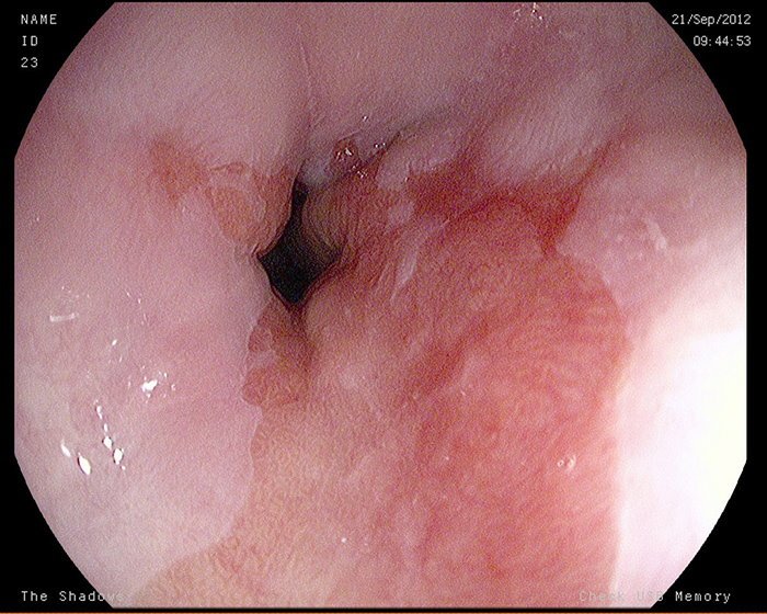 endoscopy image of oesophagus