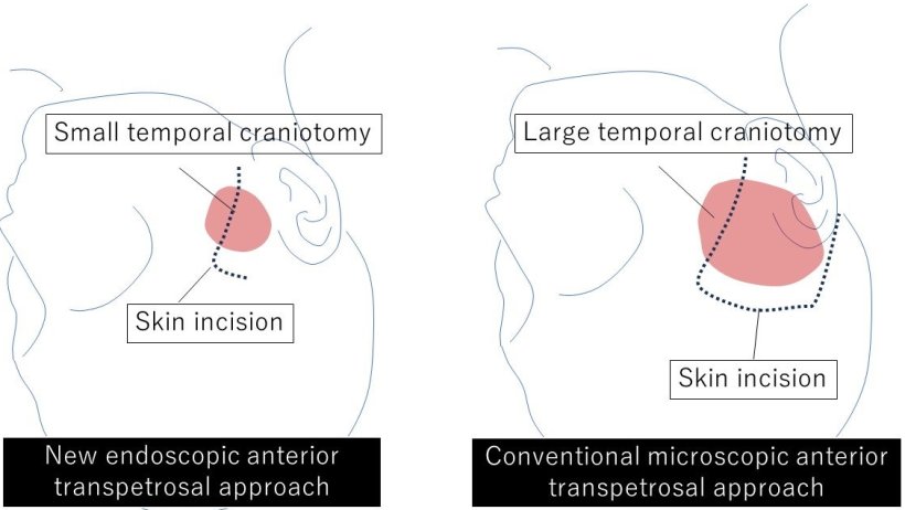 Schematic illustration of craniotomy surgical techniques