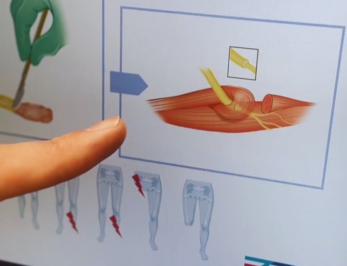 Surgeon points to a graphical schematic detailing on amputation techniques