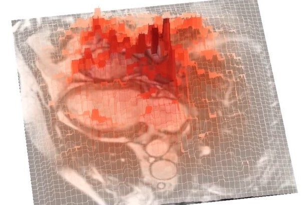 MRT-Bild des Herzens, überlagert mit roten 3D-Balken aus einer KI-Analyse