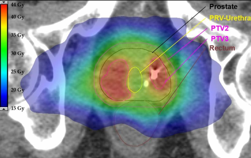 PET/MR-Aufnahme einer Strahlentherapie bei Prostatakrebs. Die roten Flächen...
