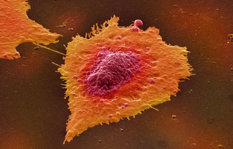 Microscopic image of human colon cancer cells