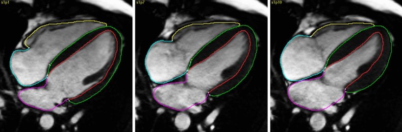 Three cardiac magnetic resonance scans acros vrrious stages of a heartbeat...