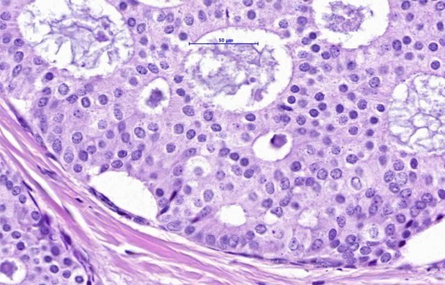 H&E stained slide of DCIS in breast tissue