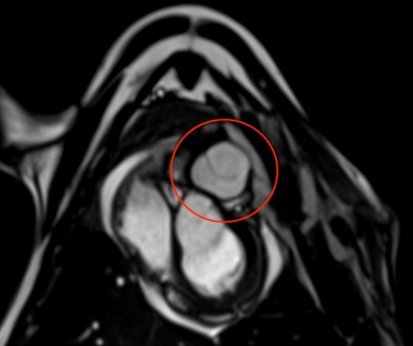 MRI image of a pulmonary valve implant made of human collagen, circled in red