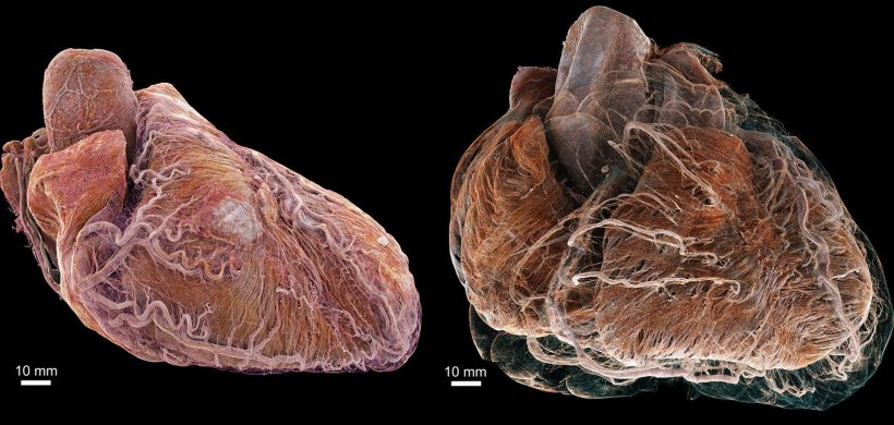 3D-gerenderte Aufnahmen zweier Herzen, links von einem gesunden Patienten,...