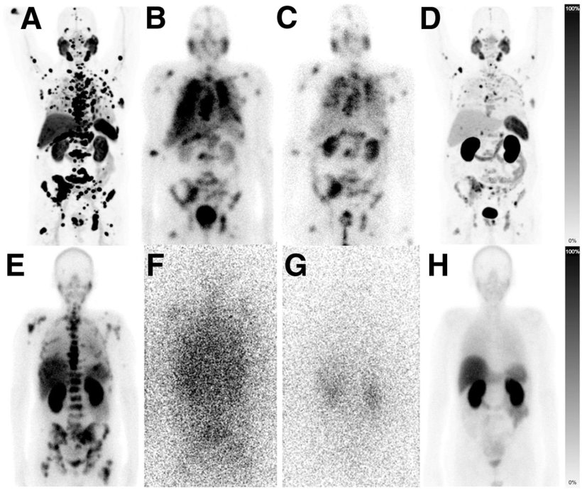 Nuclear medicine imaging of patient with metastatic prostate cancer, showing...