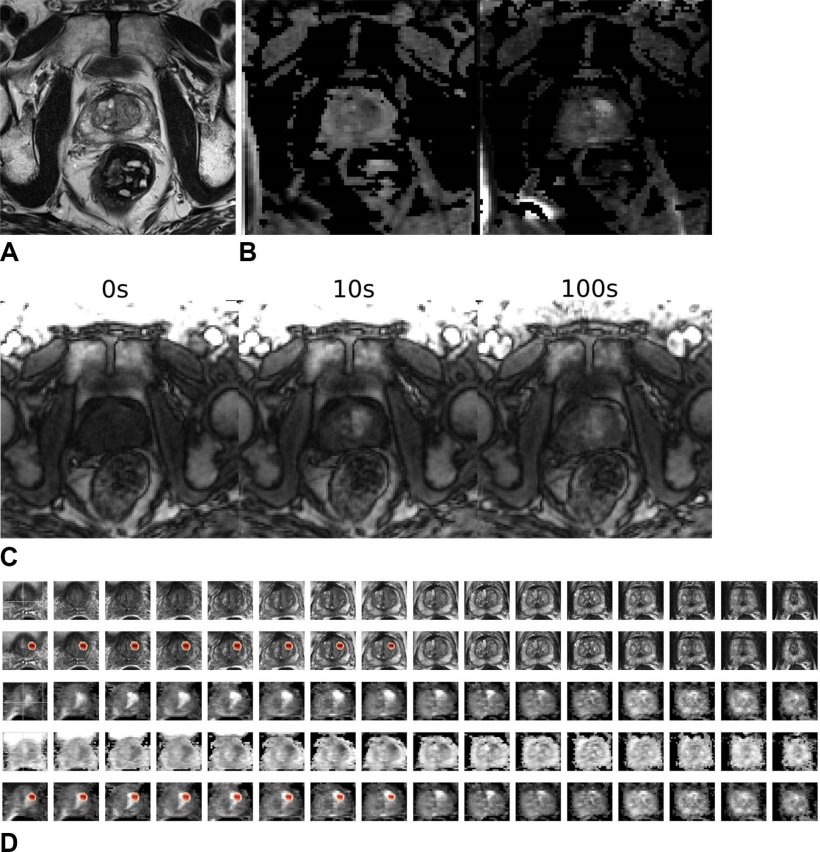 Series of prostate MRI scans