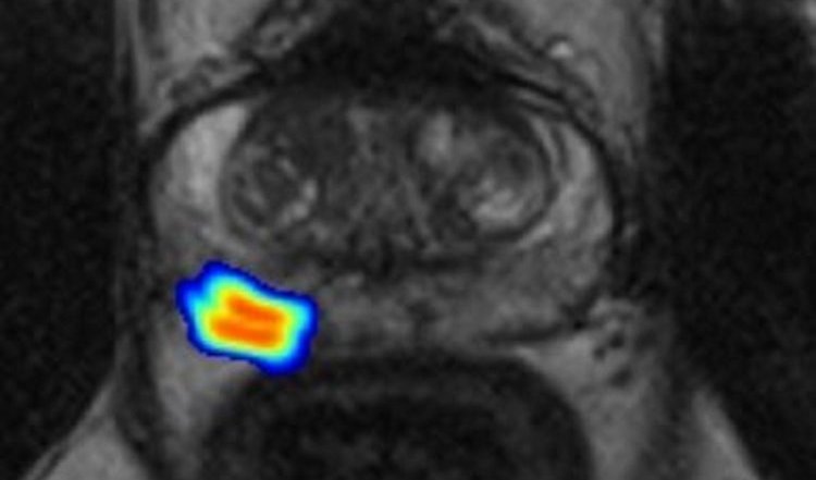 MRI scan of the abdomen, with a multicolored area marked as high-risk for...