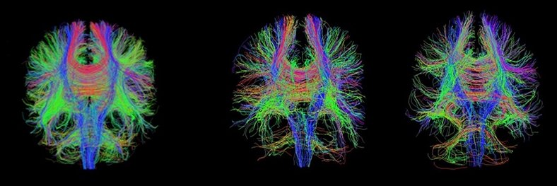 Three DTI brain scans, displaying colorful entangled fibres